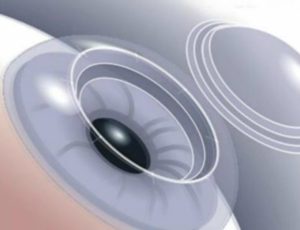 Courbure de la lentille