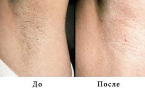 Utiliser le photoépilateur