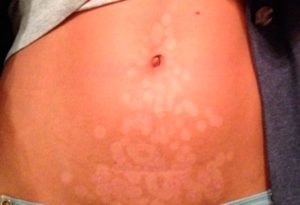 Inconvénients de l'utilisation d'un photoépilateur