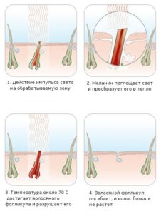 Avantages de la photoépilation.