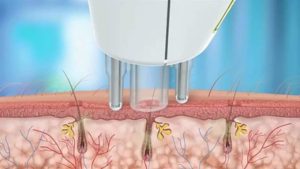 action de l'épilateur