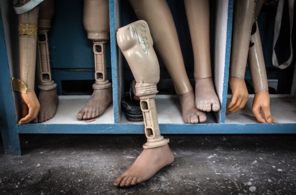 Poubelle utile. Comment les capsules de bouteilles sont recyclées en prothèses en Europe